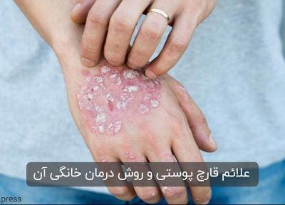 علائم و علت قارچ پوستی ، موثرترین روش برای درمان خانگی آن