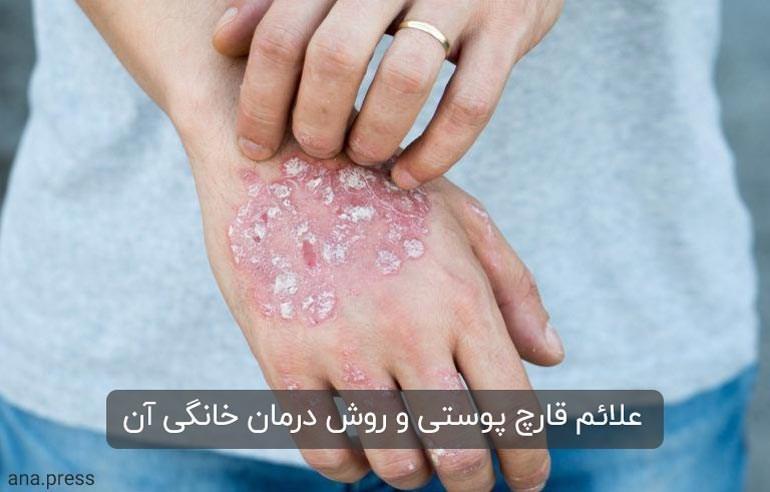 علائم و علت قارچ پوستی ، موثرترین روش برای درمان خانگی آن