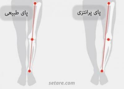 علل عارضه پای پرانتزی و روشهای درمان آن (حرکت درمانی)
